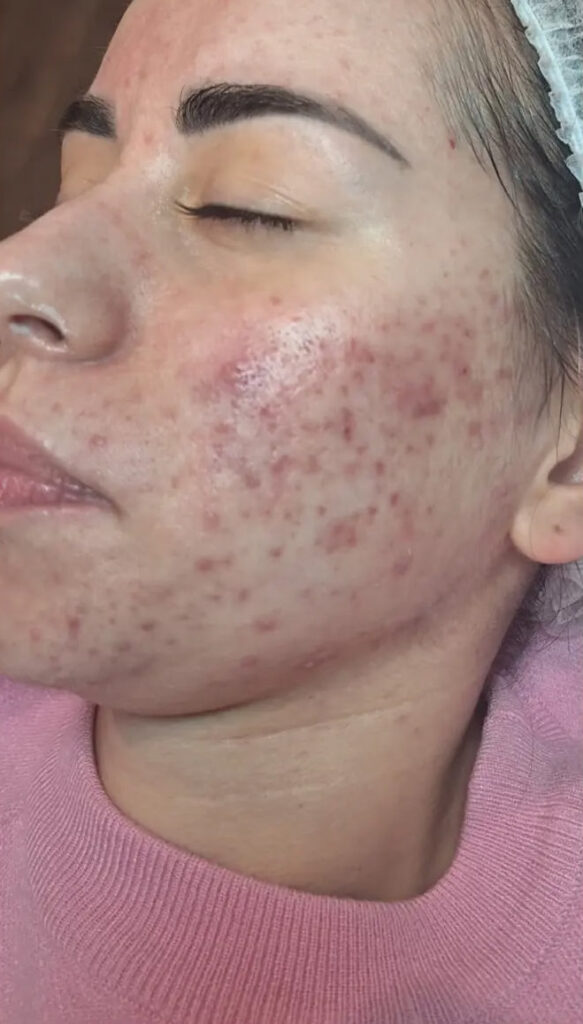 Acne 3 before