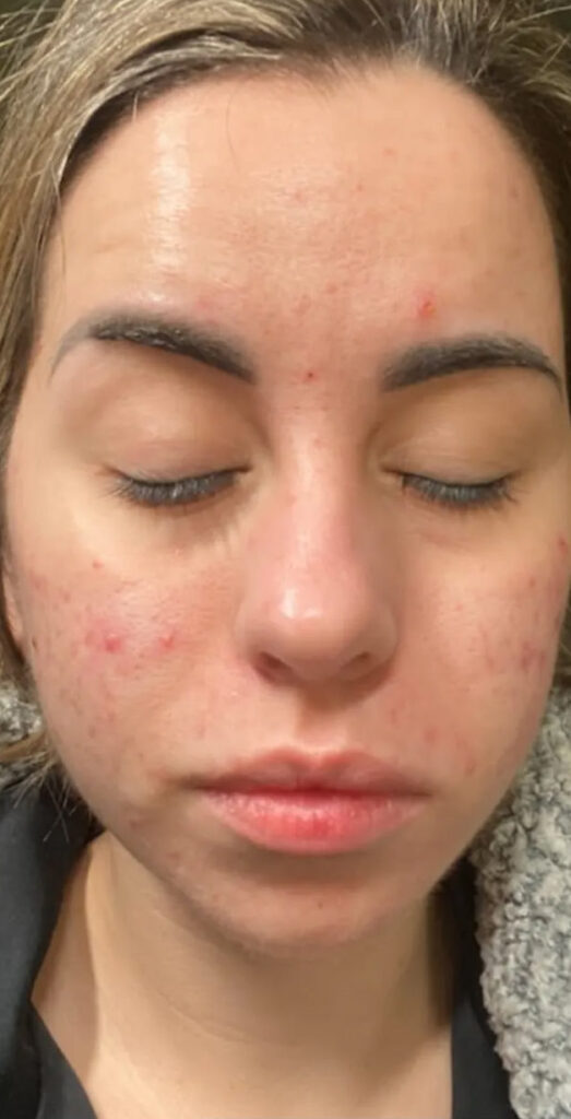 Acne after