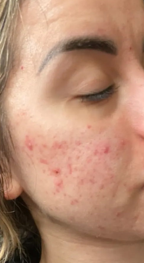 Acne2 after