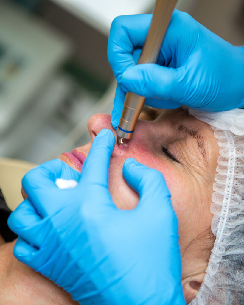Removal of blood vessels by laser on the face