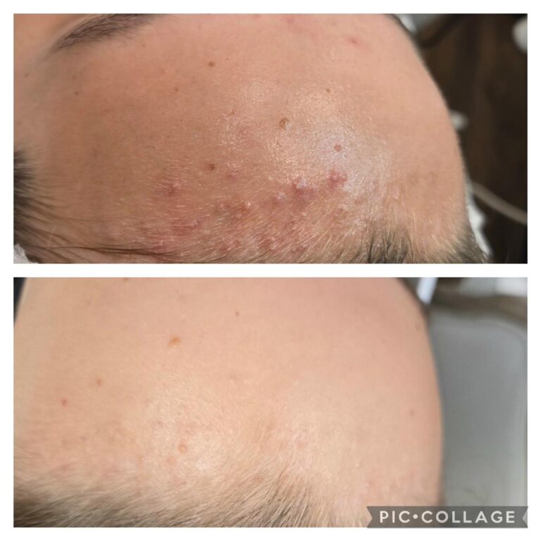 Acne forehead male