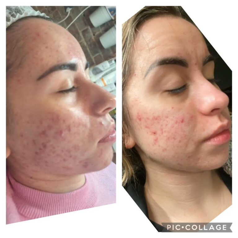 Acne full cheek profile