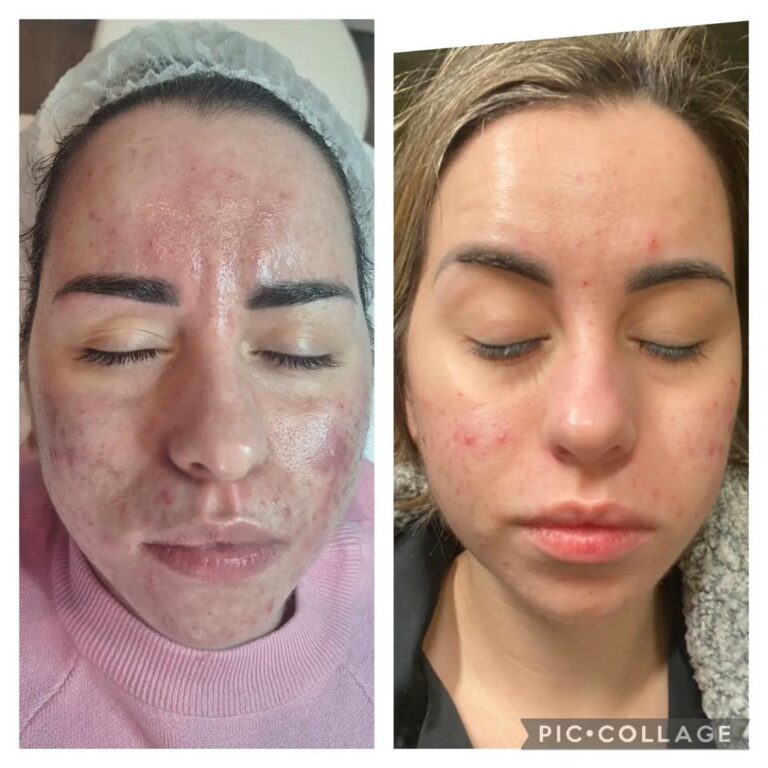 Acne full face frontal