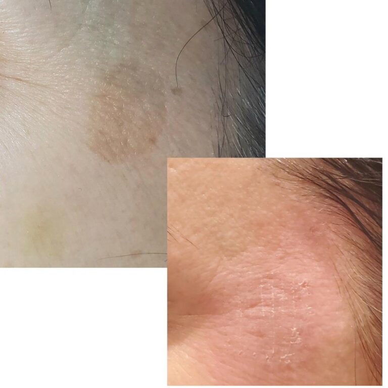 Acne pigmentation hairline
