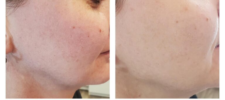 Acne pores cheek jaw