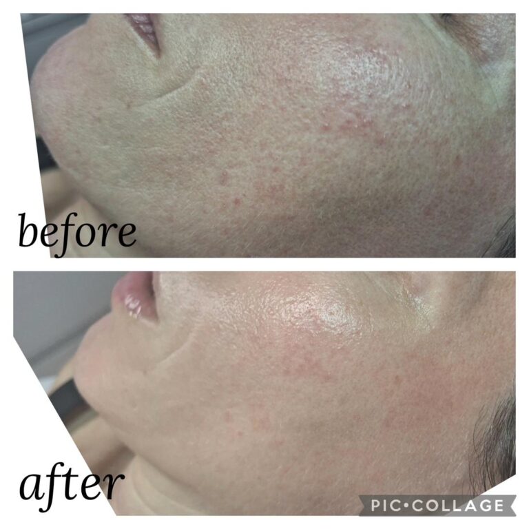 Acne rosacea cheek