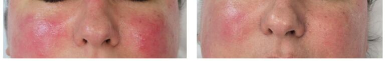 Acne rosacea cheeks