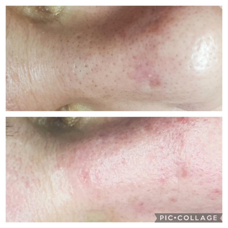 Acne rosacea nose cheek