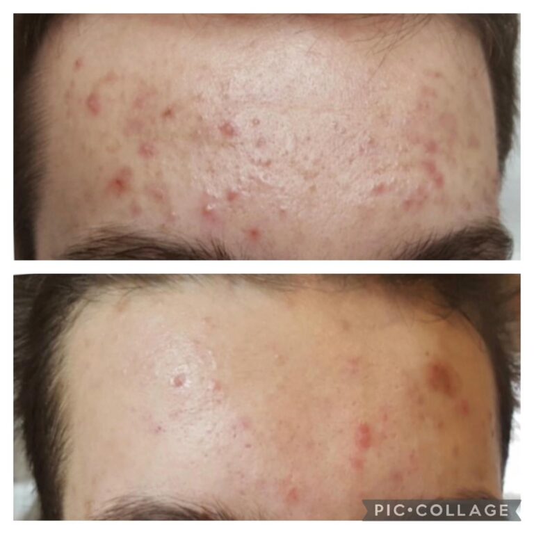 Acne severe forehead male