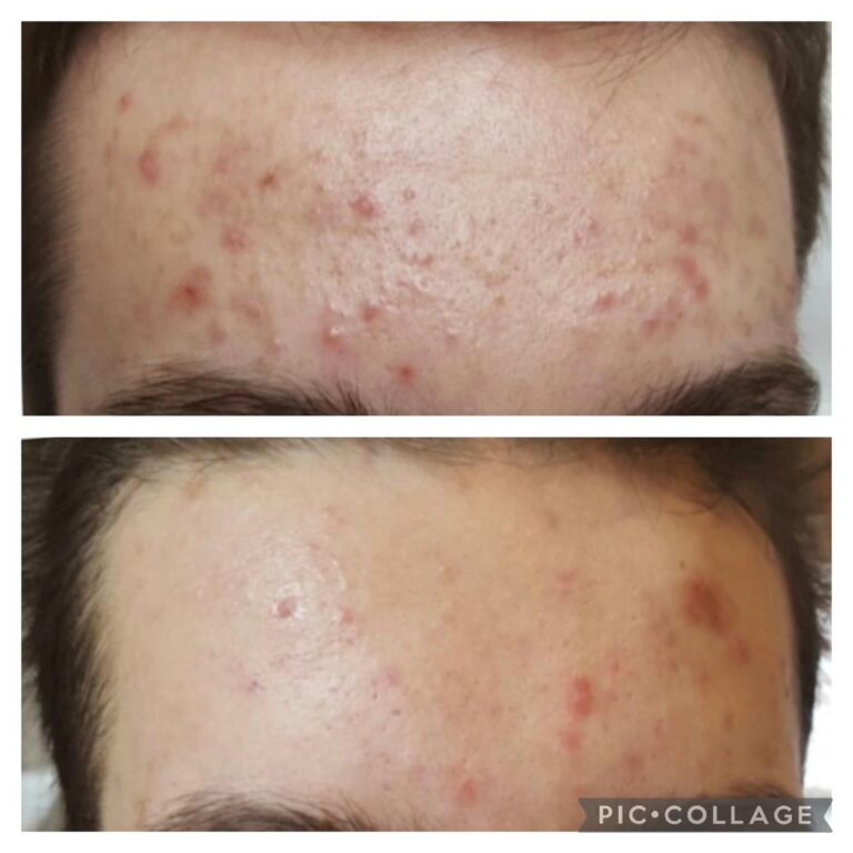 Acne severe forehead male