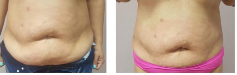 Body contouring abdomen fat