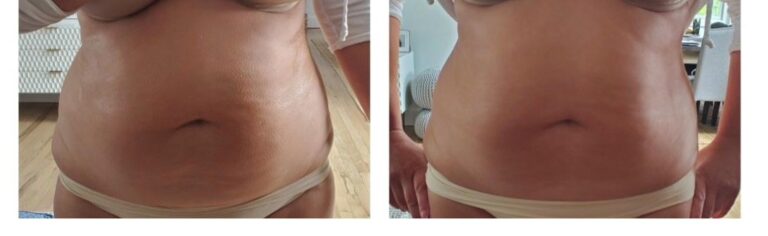 Body contouring abdomen firming