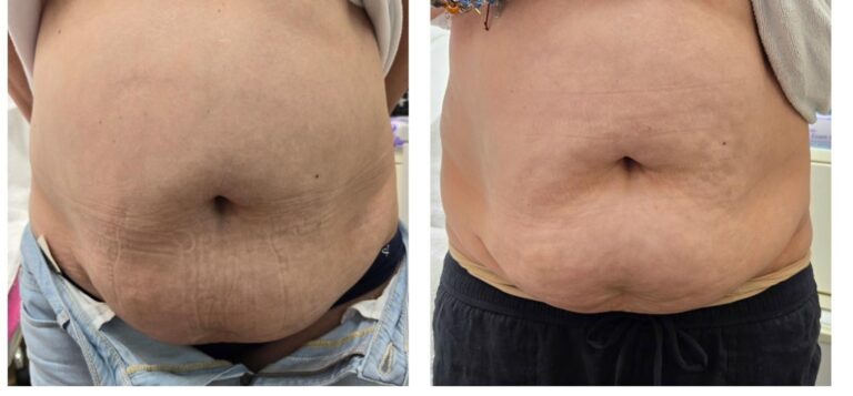 Body contouring abdomen male
