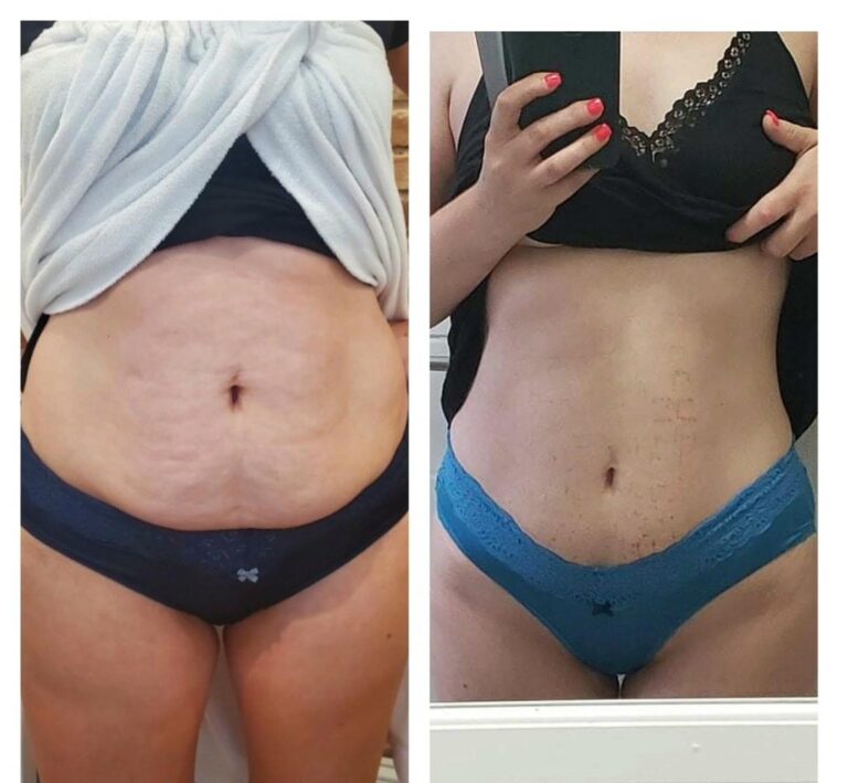 Body contouring abdomen stretchmarks