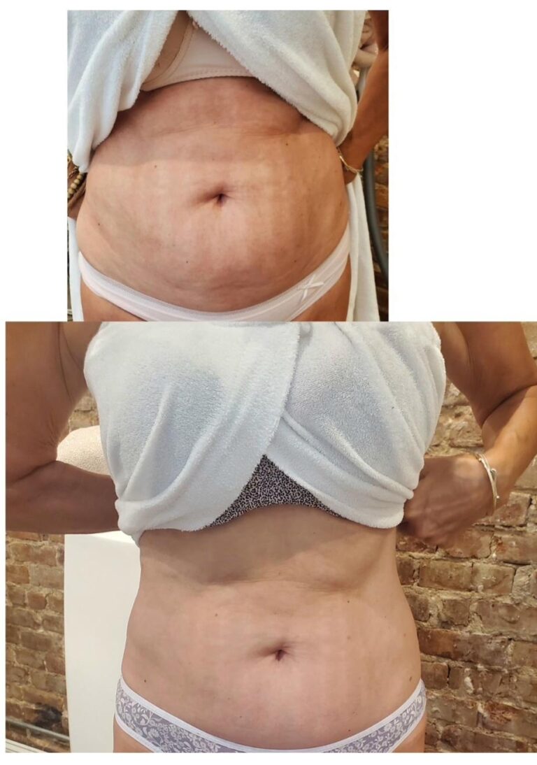 Body contouring abdomen stretchmarks