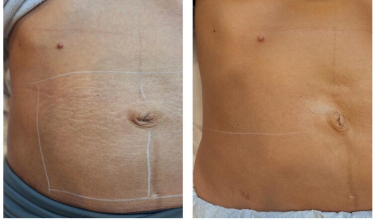 Body contouring abdomen stretchmarks