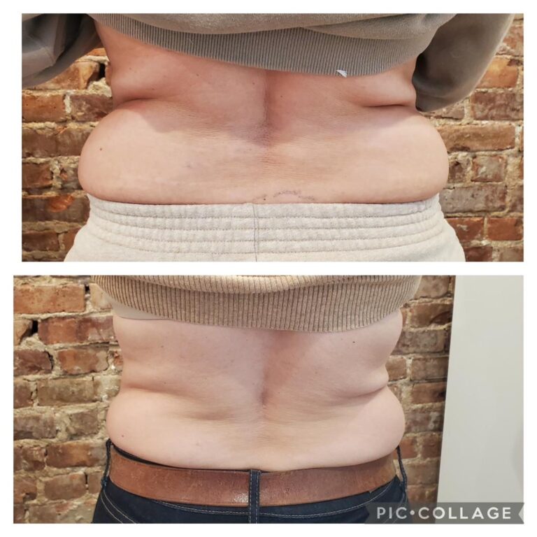 Body contouring back fat