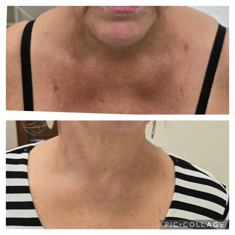 Body contouring neck decollete