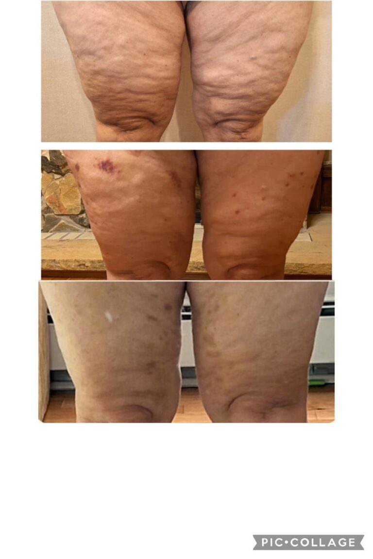 Body contouring thighs cellulite