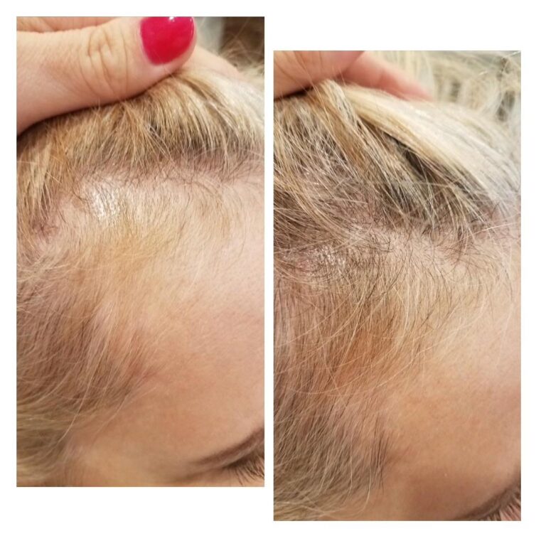 Hair loss crown blonde