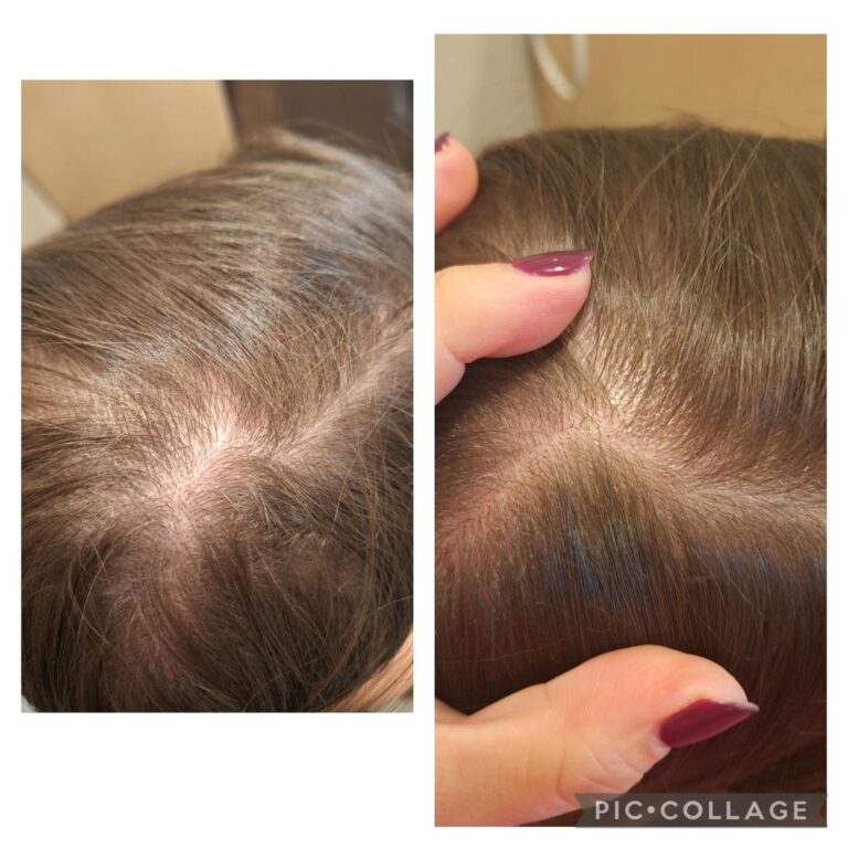Hair loss crown brunette