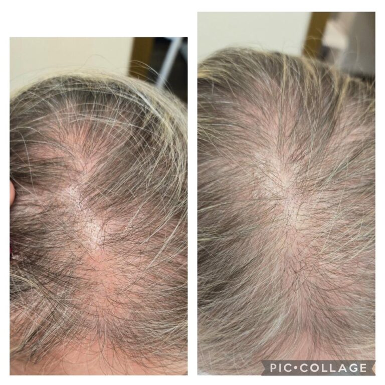 Hair loss crown grey