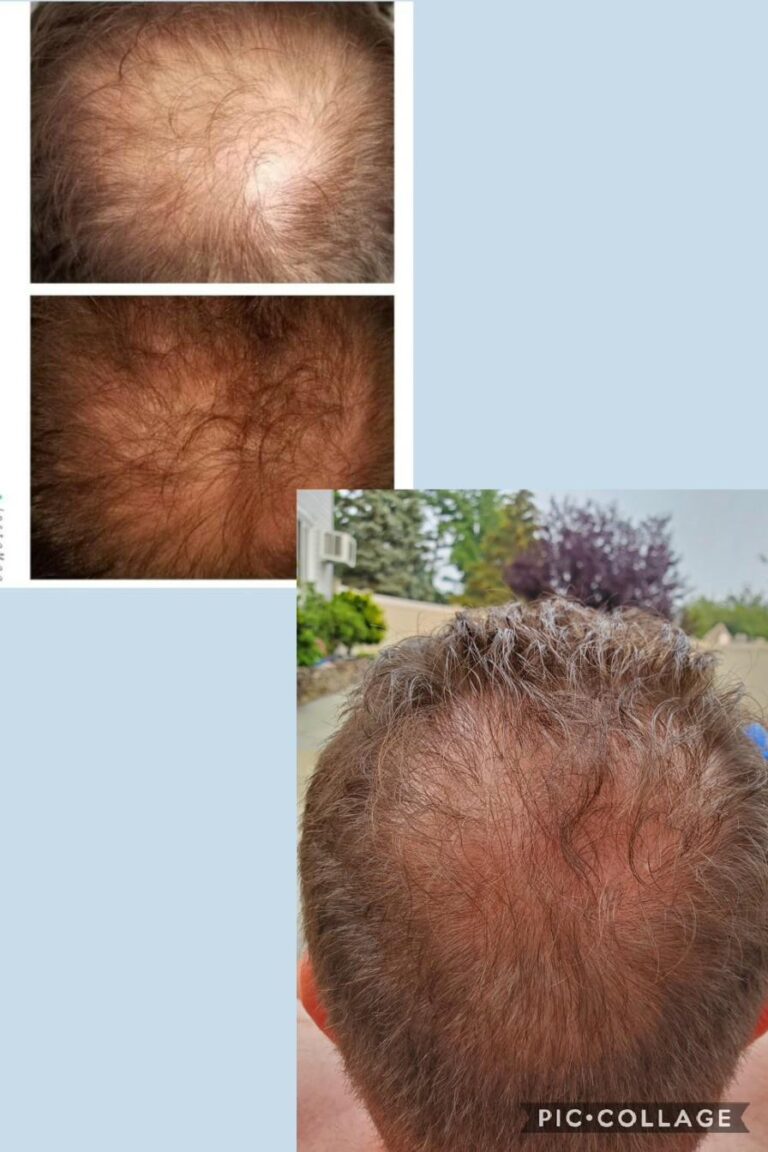 Hair loss crown male series