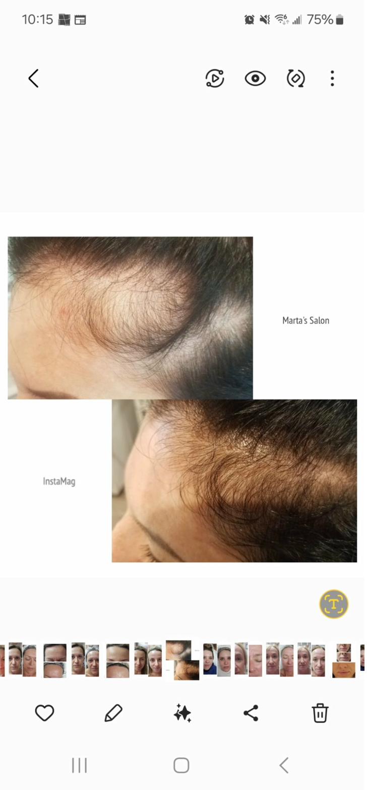 Hair loss hairline