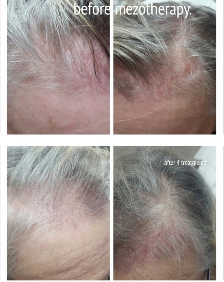 Hair loss mesotherapy series