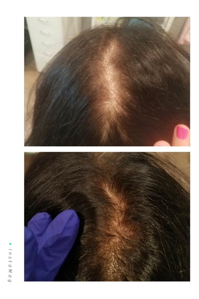 Hair loss parting brunette