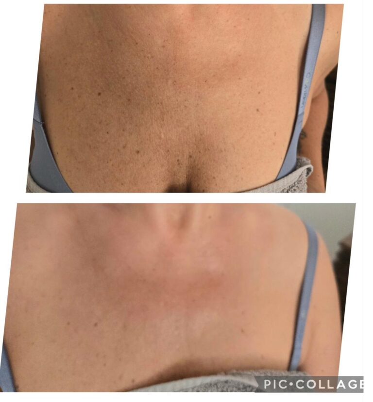 Pigmentation back decollete