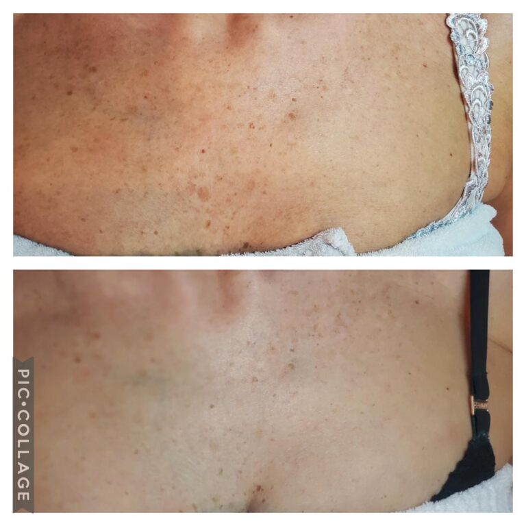 Pigmentation decollete