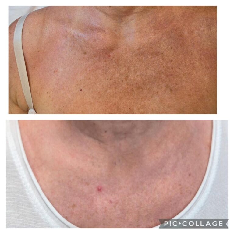 Pigmentation decollete chest