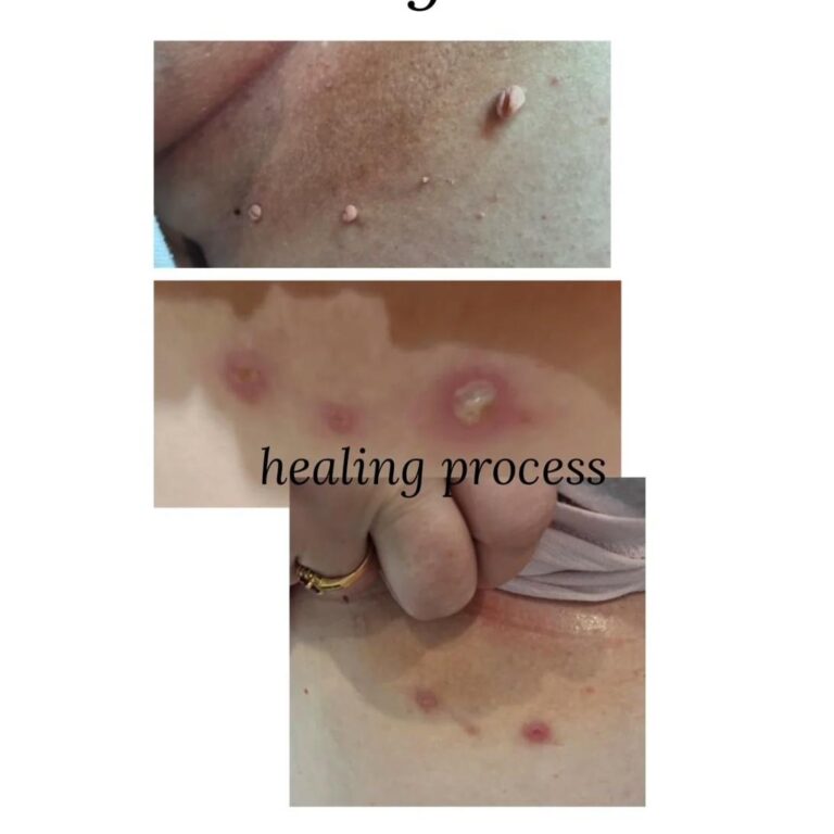 Skin tags removal healing