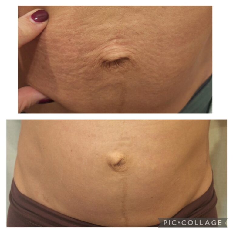 Stretch marks abdomen