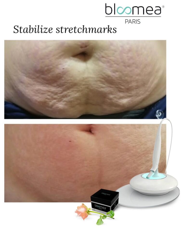 Stretch marks abdomen bloomea
