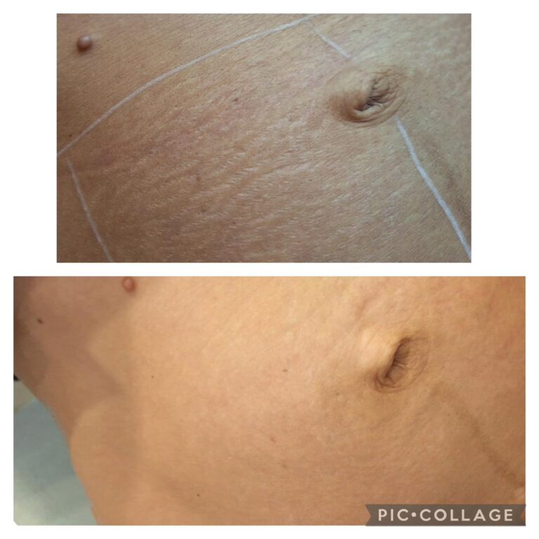 Stretch marks abdomen closeup