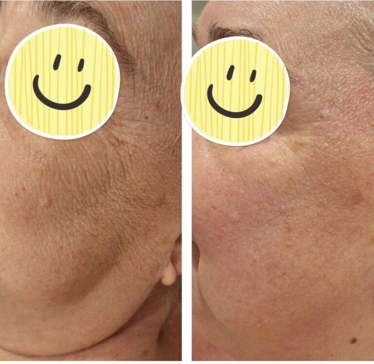 Wrinkles cheek closeup