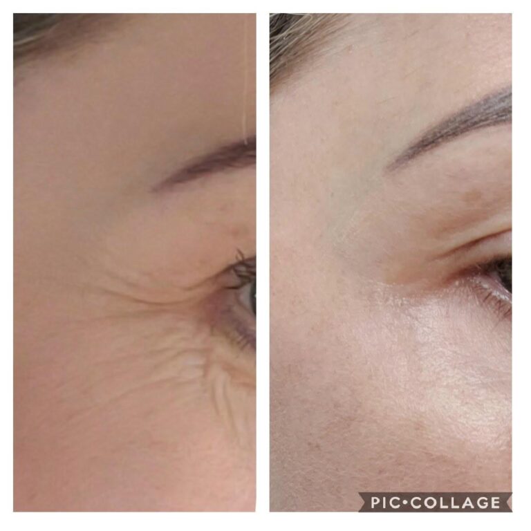 Wrinkles crows feet eye