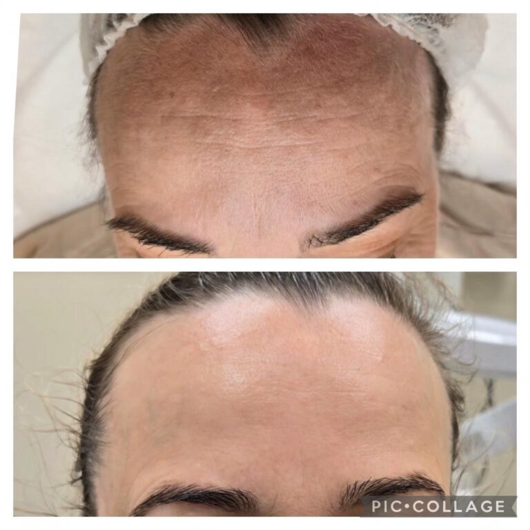 Wrinkles forehead deep