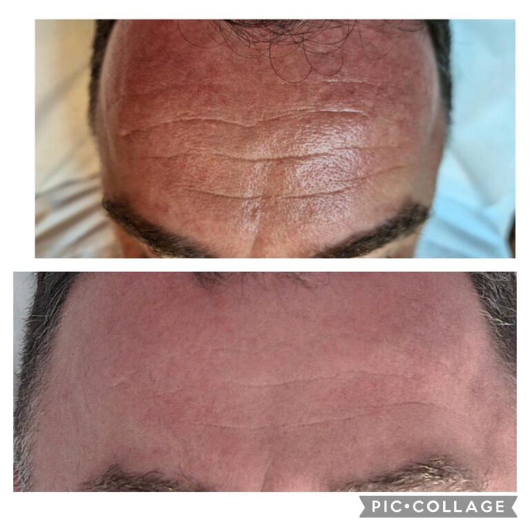 Wrinkles forehead male