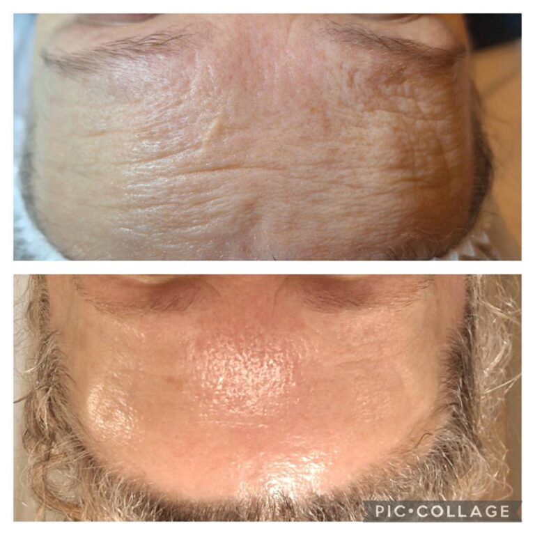 Wrinkles forehead male