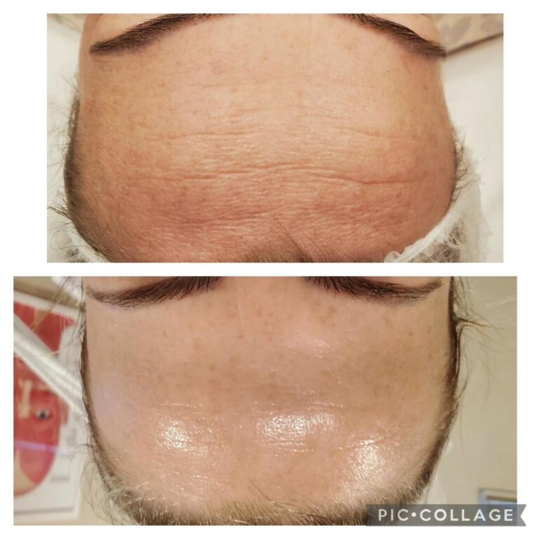 Wrinkles forehead male