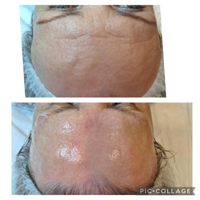 Wrinkles forehead male