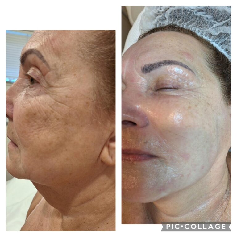 Wrinkles full face profile