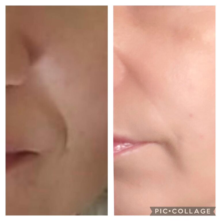 Wrinkles nasolabial mouth