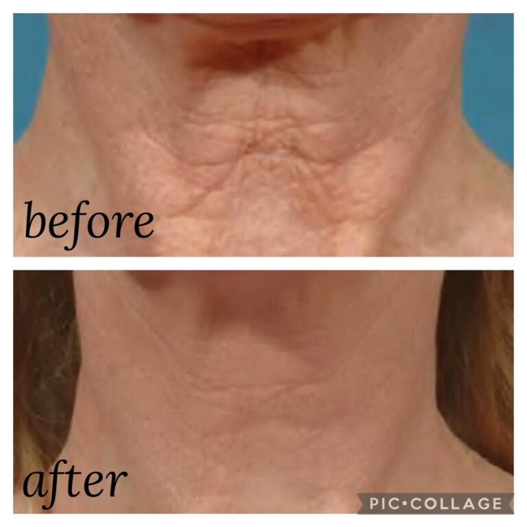 Wrinkles neck before after