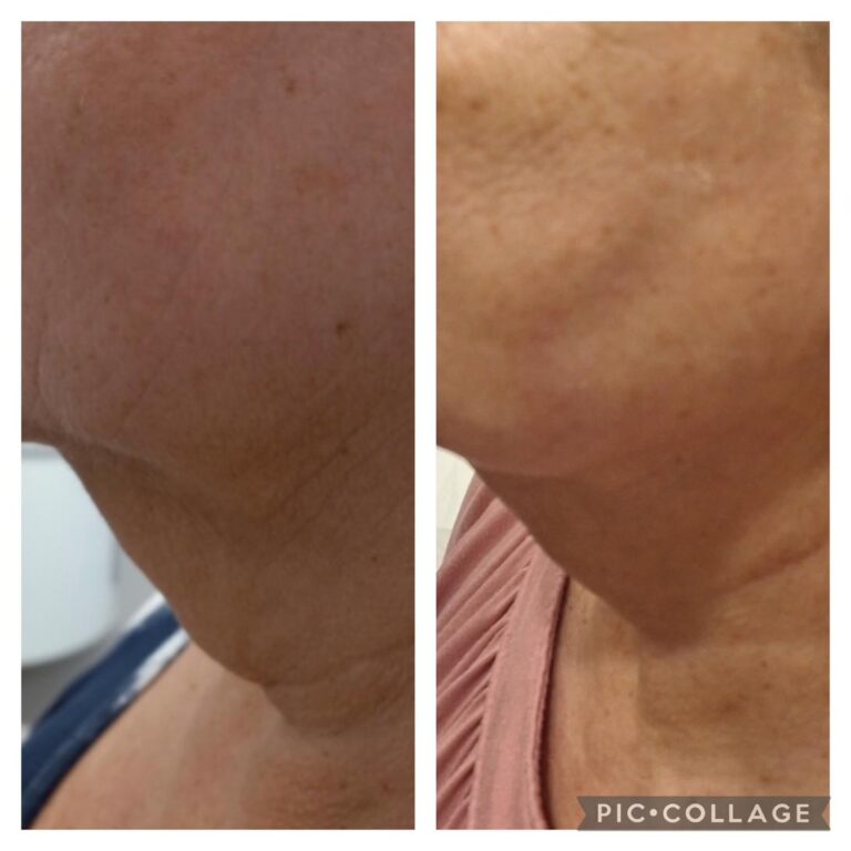 Wrinkles neck lateral